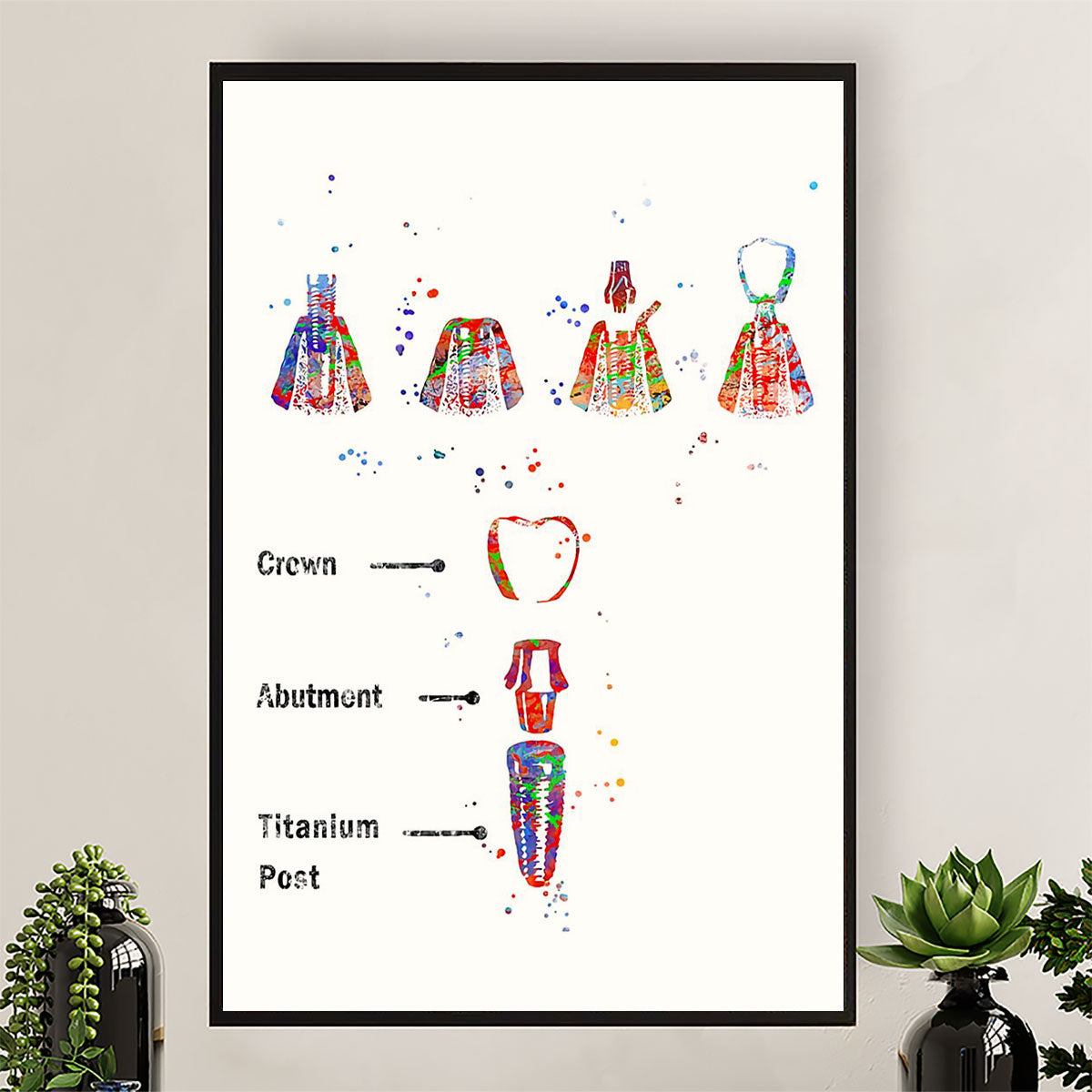 Dental Poster Implant Procedure | Wall Art Gift for Dentist