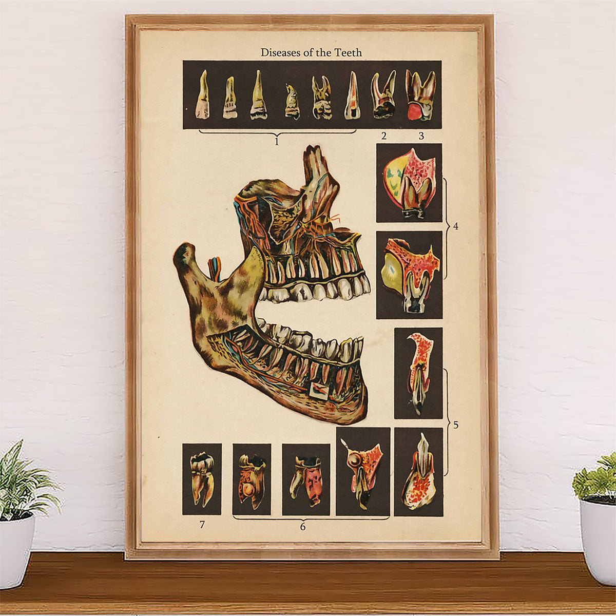 Dental Poster Diseases of the Teeth | Wall Art Gift for Dentist