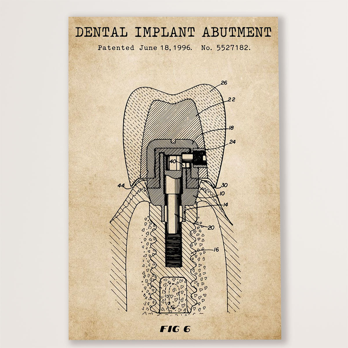 Dental Poster Dental Implant Abutment | Wall Art Gift for Dentist