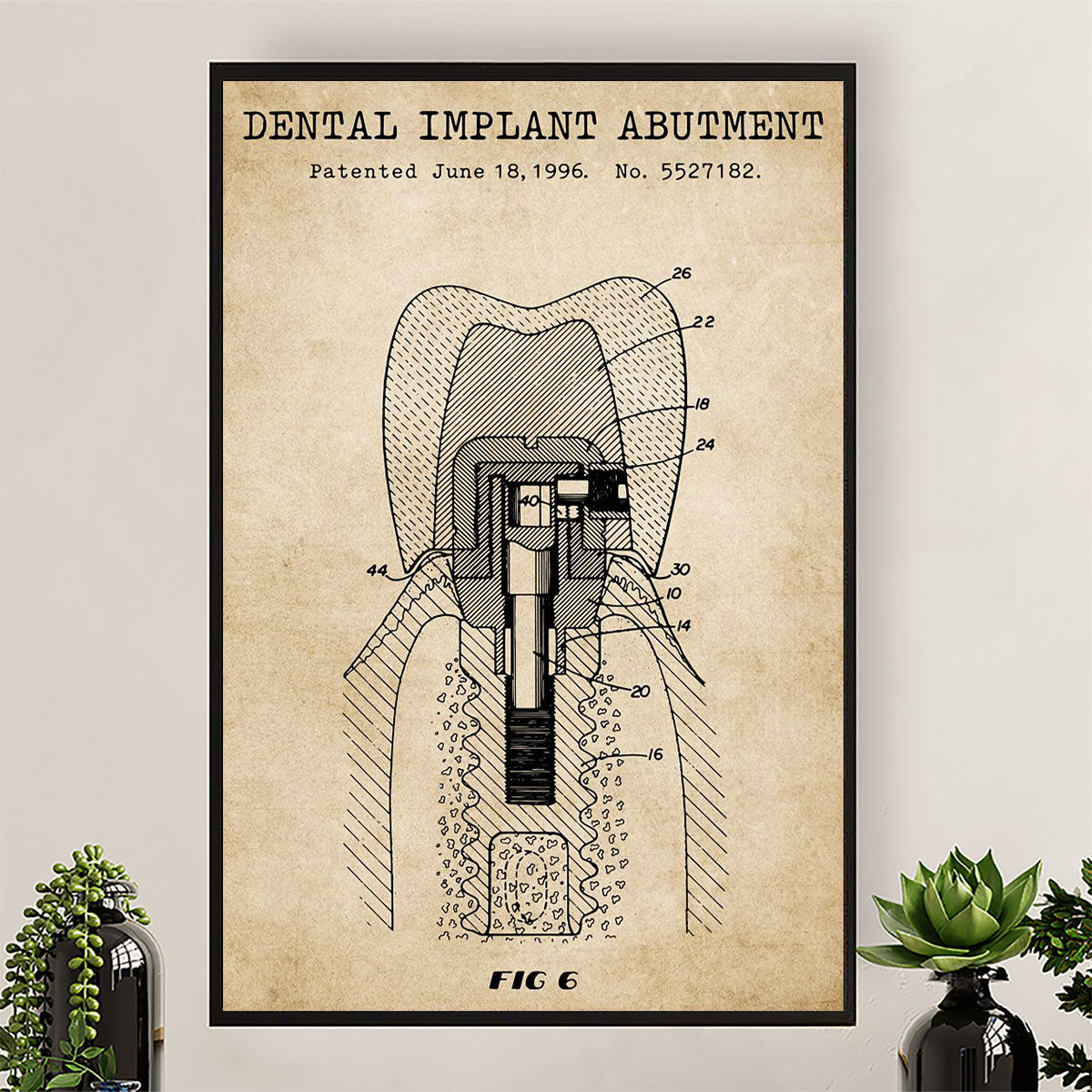 Dental Poster Dental Implant Abutment | Wall Art Gift for Dentist