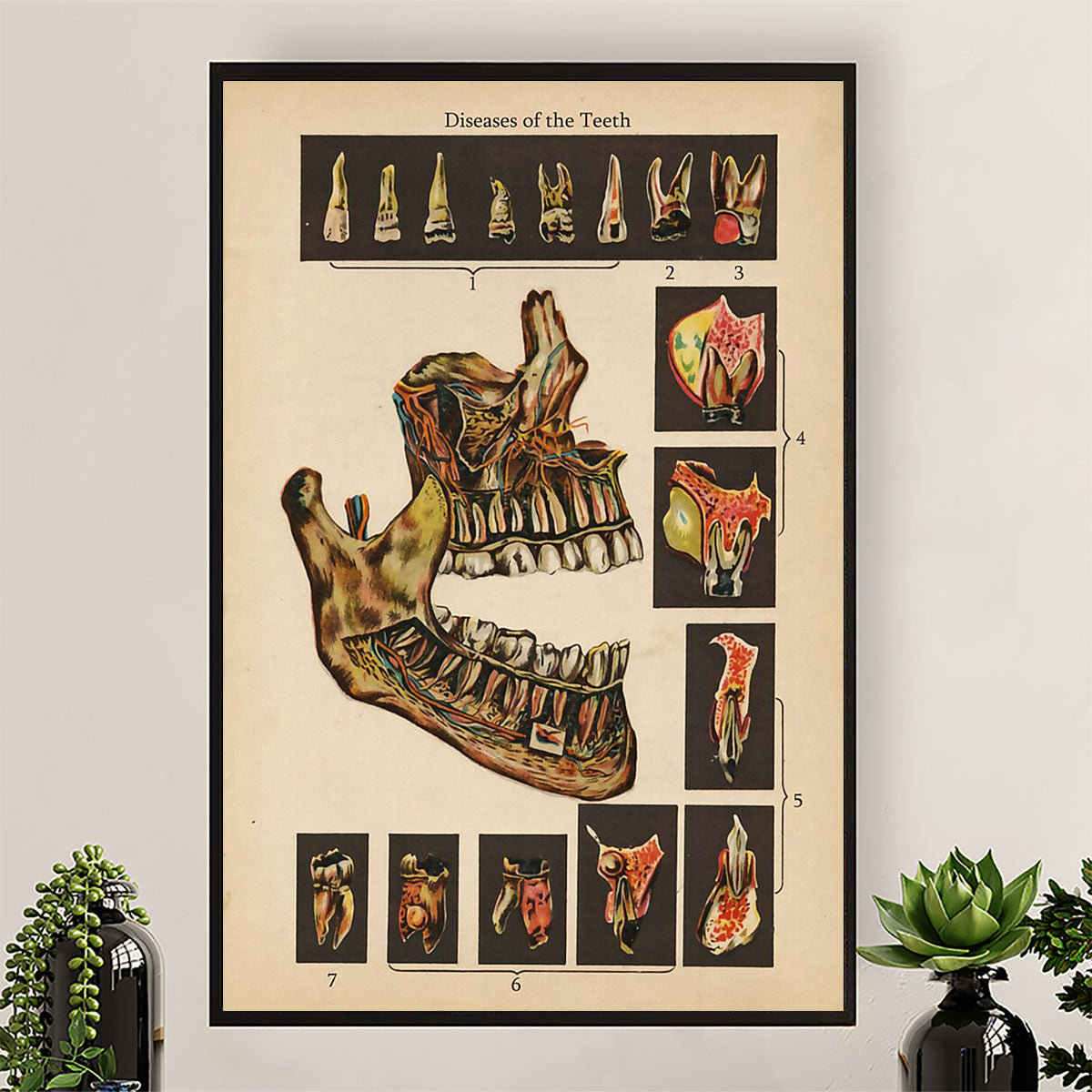 Dental Canvas Diseases of the Teeth | Wall Art Gift for Dentist
