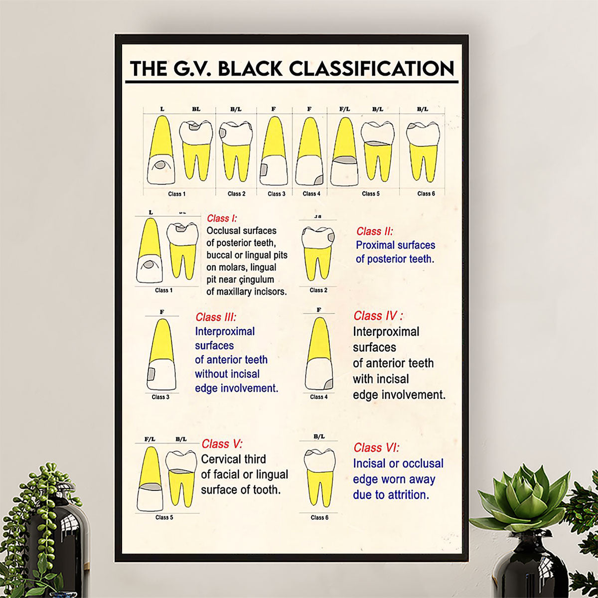 Dental Poster The G.V Black Classification | Wall Art Gift for Dentist