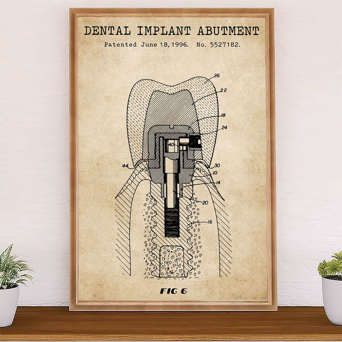 Dental Poster Dental Implant Abutment | Wall Art Gift for Dentist