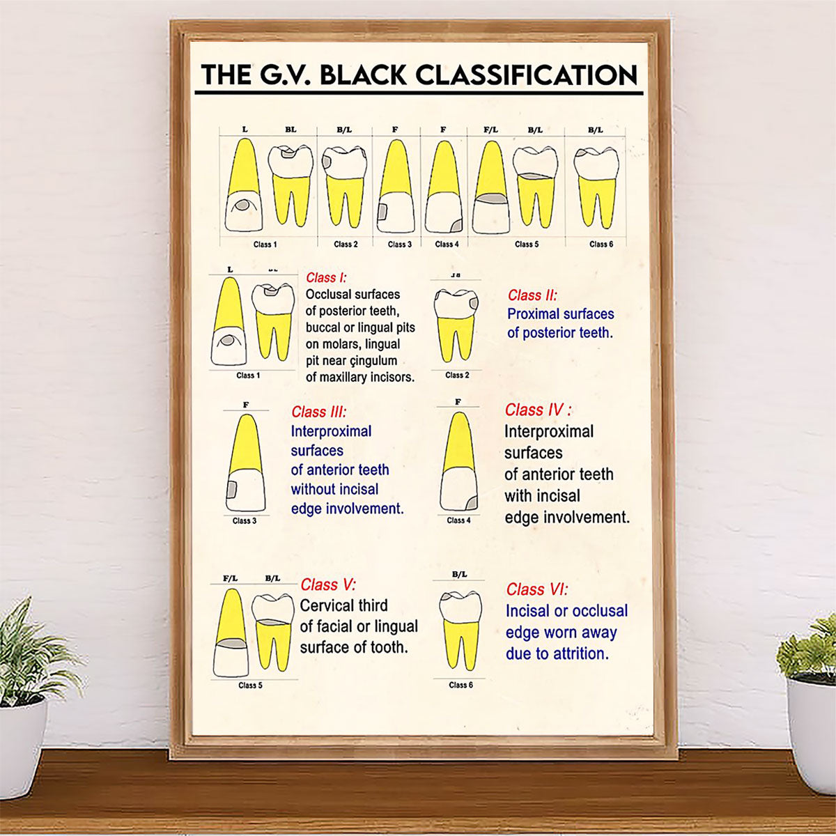 Dental Poster The G.V Black Classification | Wall Art Gift for Dentist
