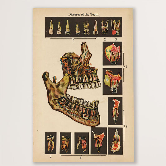 Dental Canvas Diseases of the Teeth | Wall Art Gift for Dentist