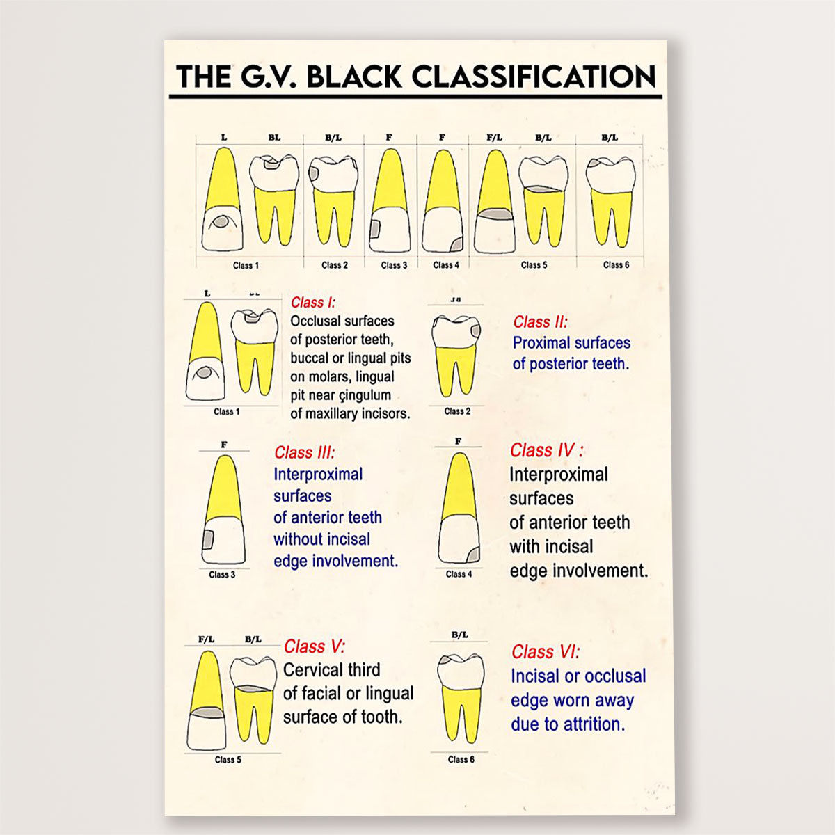 Dental Poster The G.V Black Classification | Wall Art Gift for Dentist
